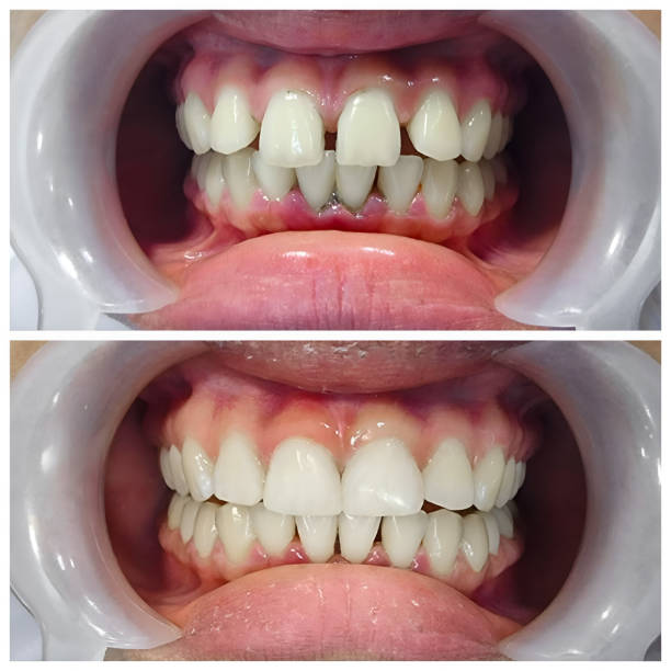 Full Mouth Reconstruction in Rose Valley, PA